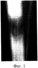 Способ оценки минерализации костного регенерата по изображениям рентгенограмм (патент 2316255)