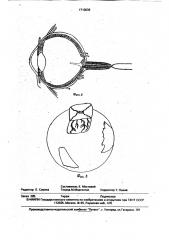 Способ изучения задних путей оттока глазного яблока (патент 1710036)