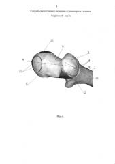 Способ оперативного лечения остеонекроза головки бедренной кости (патент 2578833)