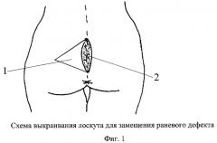 Способ лечения эпителиального копчикового хода (патент 2422104)