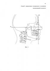 Способ определения оптимального положения окклюзионной плоскости (патент 2610531)