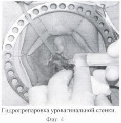 Способ маскулинизирующей уретропластики при лечении транссексуализма (патент 2371115)