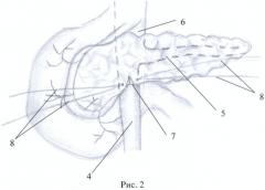Способ хирургического лечения хронического осложненного панкреатита (патент 2457791)