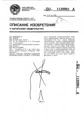 Способ лечения вывихов акромиального конца ключицы (патент 1120981)