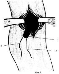 Способ лечения отрыва дистального сухожилия двуглавой мышцы плеча (патент 2284782)