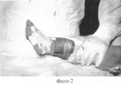 Способ пластики кожных покровов конечностей после ранней некрэктомии (патент 2248757)