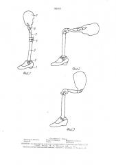Протез на короткую культю бедра (патент 1621915)