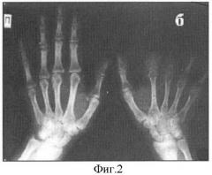 Способ подготовки к протезированию коротких культей (рудиментов) фаланг пальцев кисти (патент 2395244)