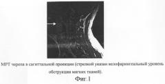 Способ определения уровня резекции мягкого неба и небного язычка у лиц голосоречевых профессий, страдающих феноменом храпа и синдромом обструктивного сонного апноэ (патент 2299676)