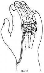 Способ реконструкции суставов пальцев кисти (патент 2355341)