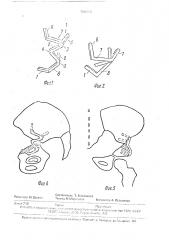 Устройство для дистракционного остеосинтеза при хирургическом лечении врожденного вывиха бедра (патент 1706598)