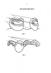 Несъемный зубной протез (патент 2602033)