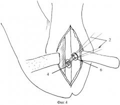 Способ лечения отрыва дистального сухожилия двуглавой мышцы плеча (патент 2300338)