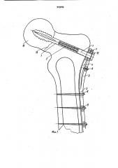 Устройство для остеосинтеза бедренной кости (патент 929086)
