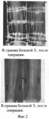 Способ удлинения сегментов конечностей (патент 2258483)