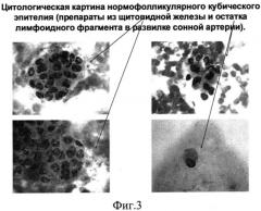 Способ фотодинамической терапии онкологических заболеваний (патент 2537759)