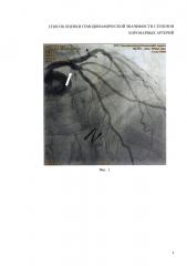 Способ оценки гемодинамической значимости стенозов коронарных артерий (ка) (патент 2622615)
