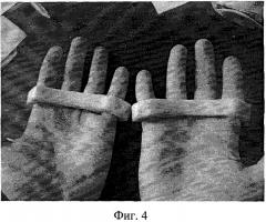 Способ профилактики и лечения послеожоговых рубцовых деформаций и синдактилий пальцев кисти (патент 2454947)