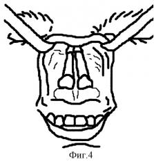 Способ коррекции комбинированных деформаций наружного носа орально-преддверным оперативным доступом (патент 2243733)