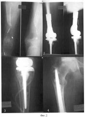 Способ лечения обширных дефектов дистального отдела бедренной кости и коленного сустава посттравматического происхождения (патент 2463983)