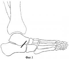Способ оперативной коррекции деформаций стопы (патент 2412661)