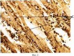 Способ патоморфологического определения давности наступления инфаркта миокарда (патент 2518333)