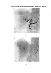 Способ эндоваскулярной химиоэмболизации печеночных артерий (патент 2655191)