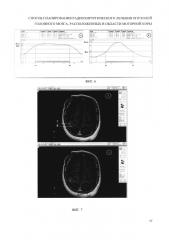 Способ планирования радиохирургического лечения опухолей головного мозга, расположенных в области моторной коры и/или прилегающих к данной области (патент 2655880)
