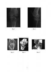 Способ остеоартропластики импрессионного полифокального перелома периферической части плато большеберцовой кости (патент 2647618)