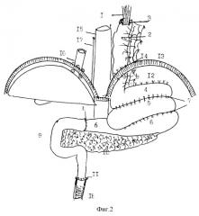 Способ формирования пищеприемника и дистальной части пищевода после гастрэктомии и резекции нижнего отдела пищевода (патент 2293526)