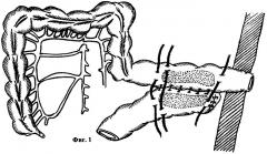 Способ двухэтапного формирования толсто-толстокишечного анастомоза (патент 2297800)