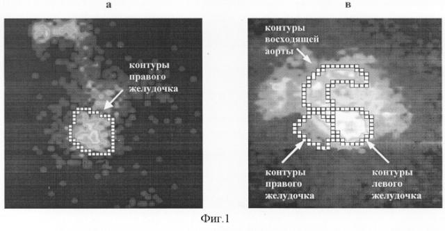 Способ топической диагностики воспалительных заболеваний сердца (патент 2244515)