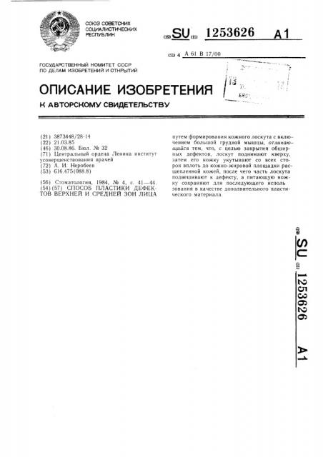 Способ пластики дефектов верхней и средней зоны лица (патент 1253626)