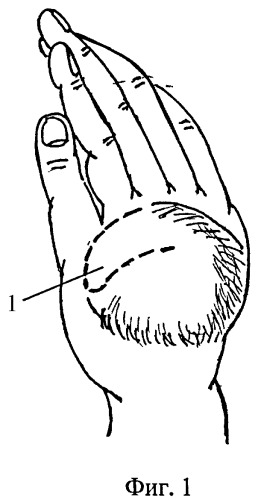 Способ устранения тяжелой рубцовой приводящей контрактуры первого луча кисти (патент 2398541)