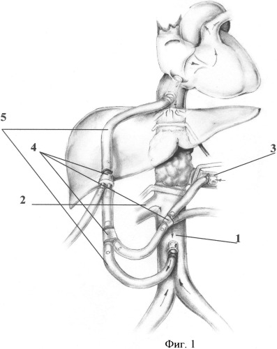 Способ временного шунтирования магистрального кровообращения при обширной резекции нижней полой вены и ее висцеральных ветвей (патент 2329773)
