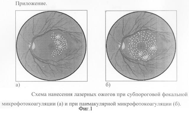 Способ модифицированной субпороговой панмакулярной микрофотокоагуляции сетчатки при диабетическом макулярном отёке (патент 2308920)