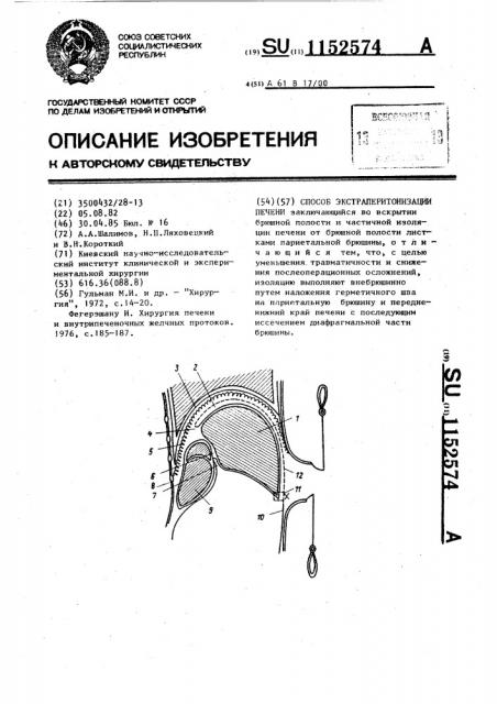 Способ экстраперитонизации печени (патент 1152574)