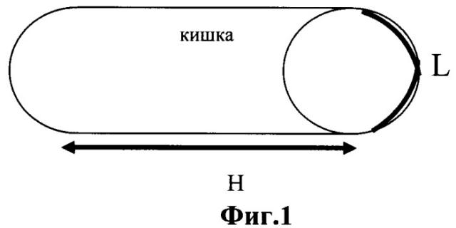 Способ определения длины резецируемой части тонкой кишки для пластики мочевого пузыря (патент 2444307)