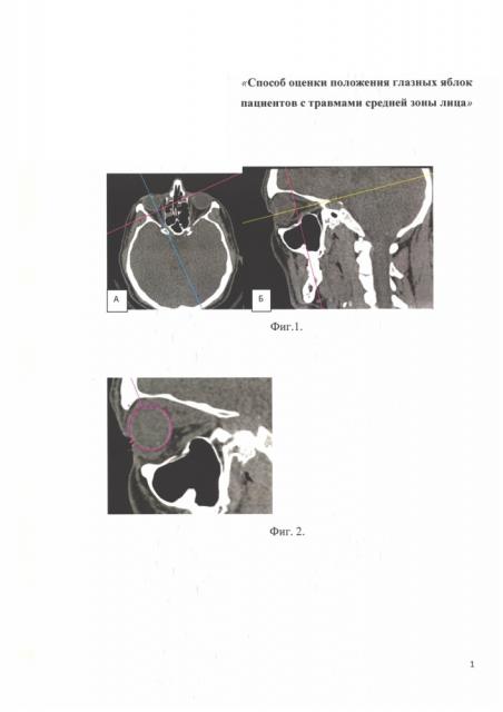 Способ оценки положения глазных яблок у пациентов с травмами средней зоны лица (патент 2661698)