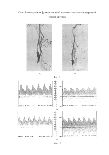 Способ определения функциональной значимости стеноза внутренней сонной артерии (патент 2588323)