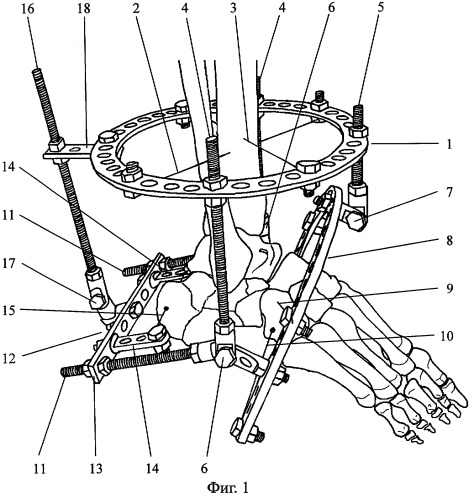 Способ лечения оскольчатых внутрисуставных переломов пяточной кости (патент 2297802)