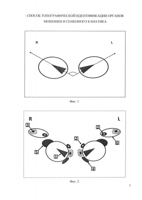 Способ топографической идентификации органов мошонки и семенного канатика (патент 2624517)