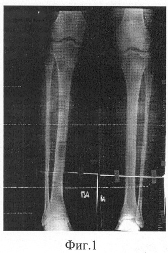 Способ удлинения трубчатой кости (патент 2271766)