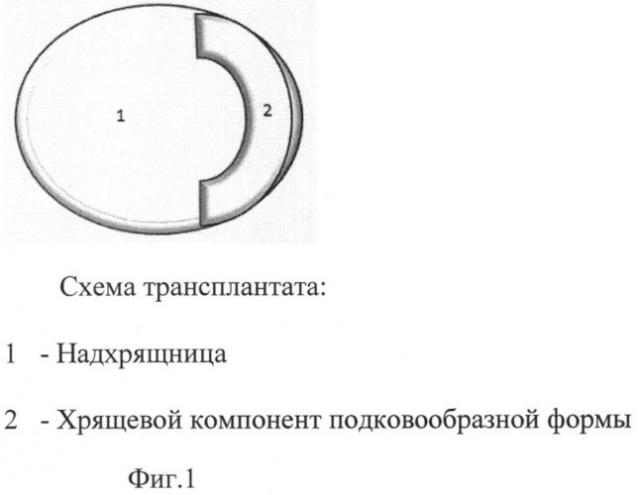 Способ формирования неотимпанальной мембраны при субтотальных дефектах барабанной перепонки (патент 2537785)