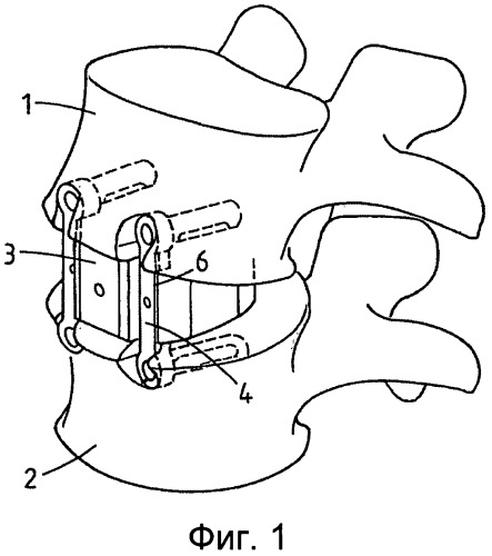 Устройство для стабилизации позвоночника, способ и набор для его имплантации (патент 2535775)