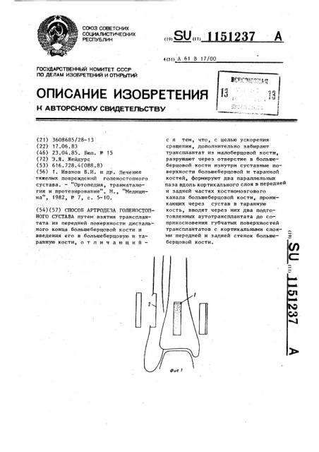 Способ артродеза голеностопного сустава (патент 1151237)