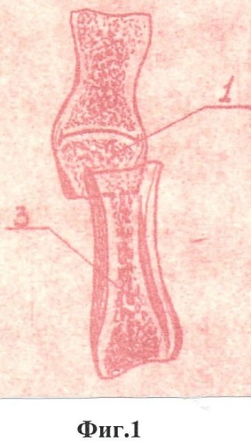 Способ артропластики межфаланговых суставов пальцев кисти (патент 2465854)