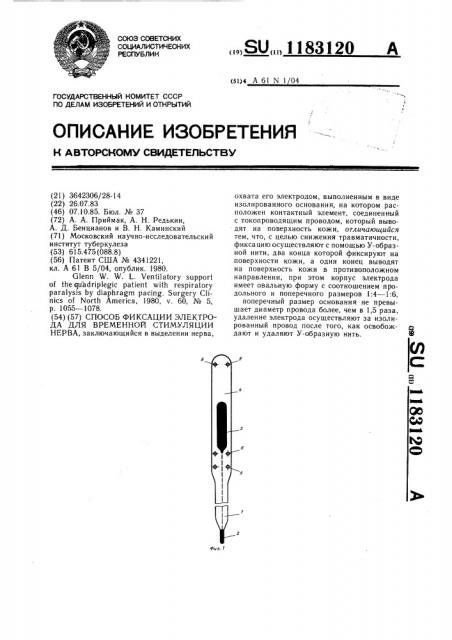 Способ фиксации электрода для временной стимуляции нерва (патент 1183120)