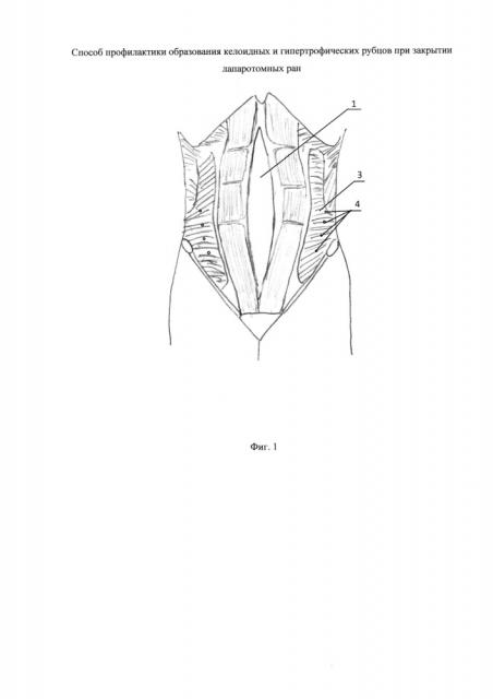 Способ профилактики образования келоидных и гипертрофических рубцов при закрытии лапаротомных ран (патент 2643332)