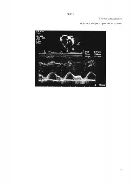 Способ определения фракции выброса правого желудочка сердца (патент 2613427)